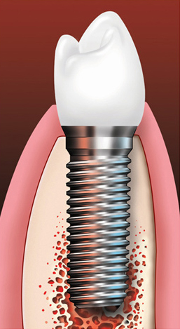 Anatomy Implant
