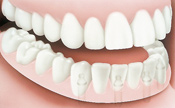 Dentures Implants