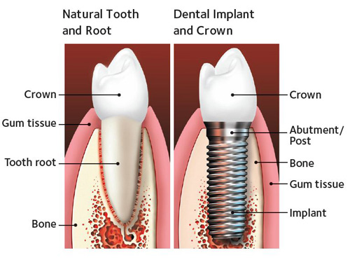 Single Implant