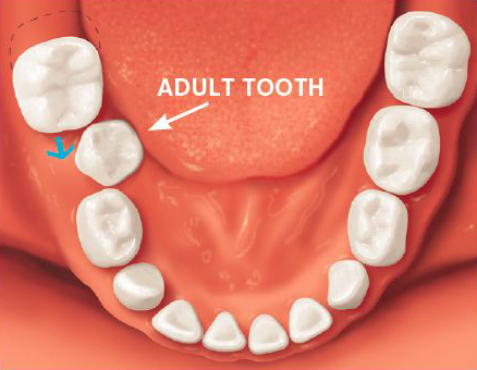 Adult Tooth Crowded English