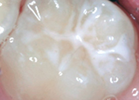 Tooth surface protected by a sealant