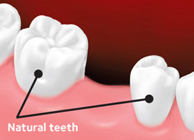 Before the bridge, teeth are shown with the space where a tooth has been lost.