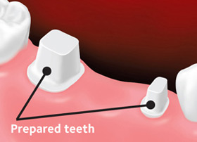 Teeth next to the gap are prepared for placement of the bridge.