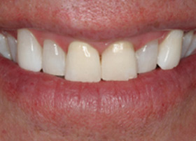 After in-office whitening